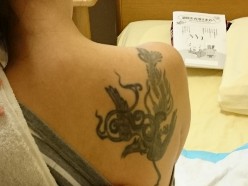施術中に見える患者の背中の龍の刺青