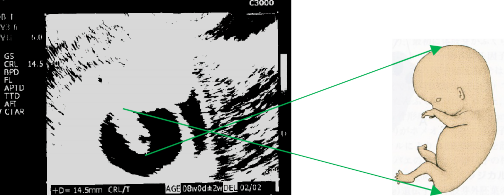 エコー画像と胎児のイラストを比較した図