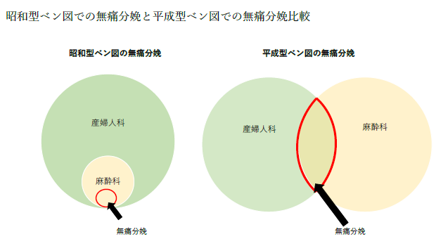 昭和型と平成型のベン図で無痛分娩を比較した図