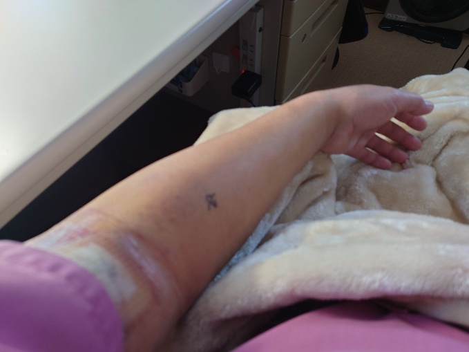 点滴の管が固定された腕の写真